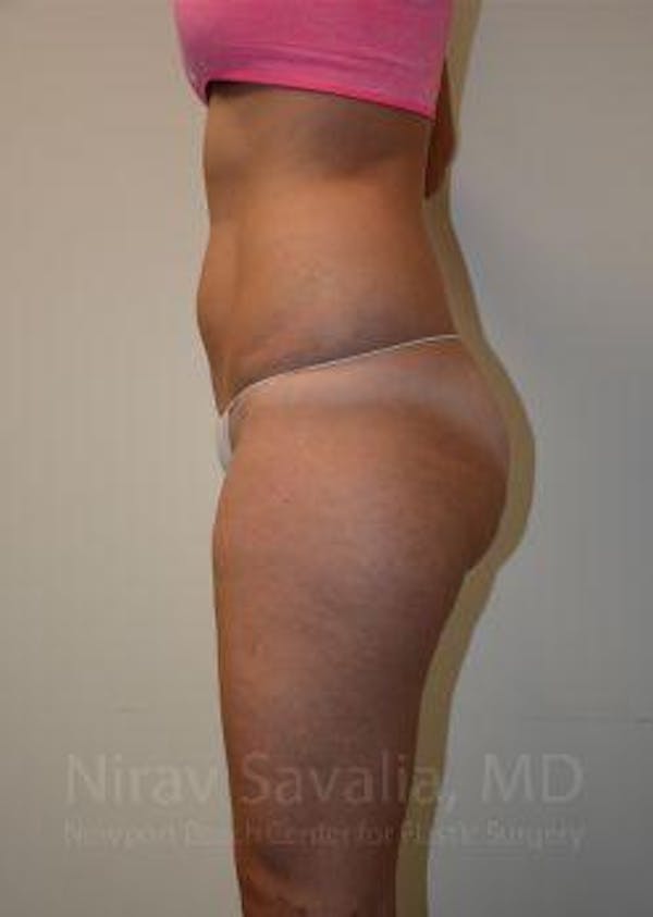 Oncoplastic Reconstruction Before & After Gallery - Patient 1655642 - Before