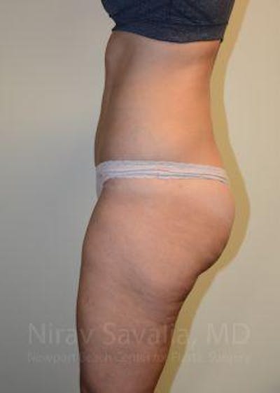 Thigh Lift Before & After Gallery - Patient 1655642 - After