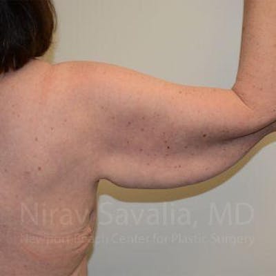 Breast Explantation En Bloc Capsulectomy Before & After Gallery - Patient 1655643 - Before