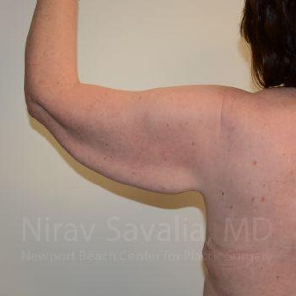 Liposuction Before & After Gallery - Patient 1655643 - Before