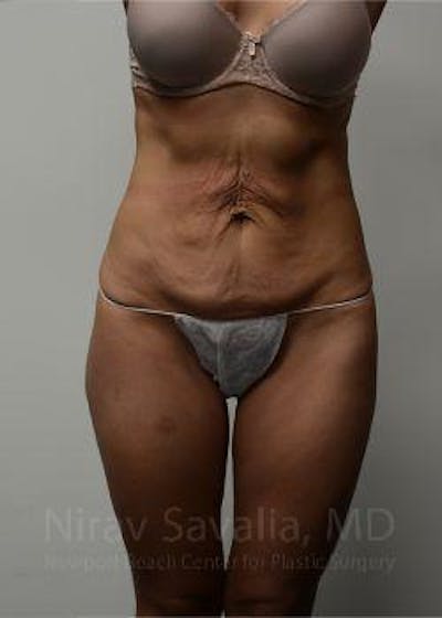 Thigh Lift Before & After Gallery - Patient 1655645 - Before