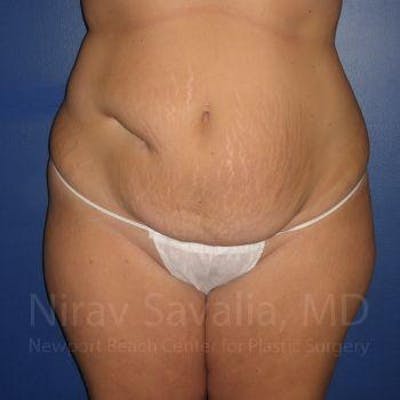 Abdominoplasty Tummy Tuck Before & After Gallery - Patient 1655647 - Before