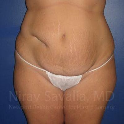 Breast Explantation En Bloc Capsulectomy Before & After Gallery - Patient 1655647 - Before