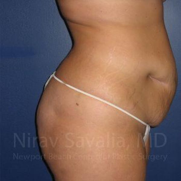 Mastectomy Reconstruction Before & After Gallery - Patient 1655647 - Before