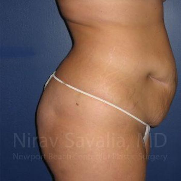 Thigh Lift Before & After Gallery - Patient 1655647 - Before