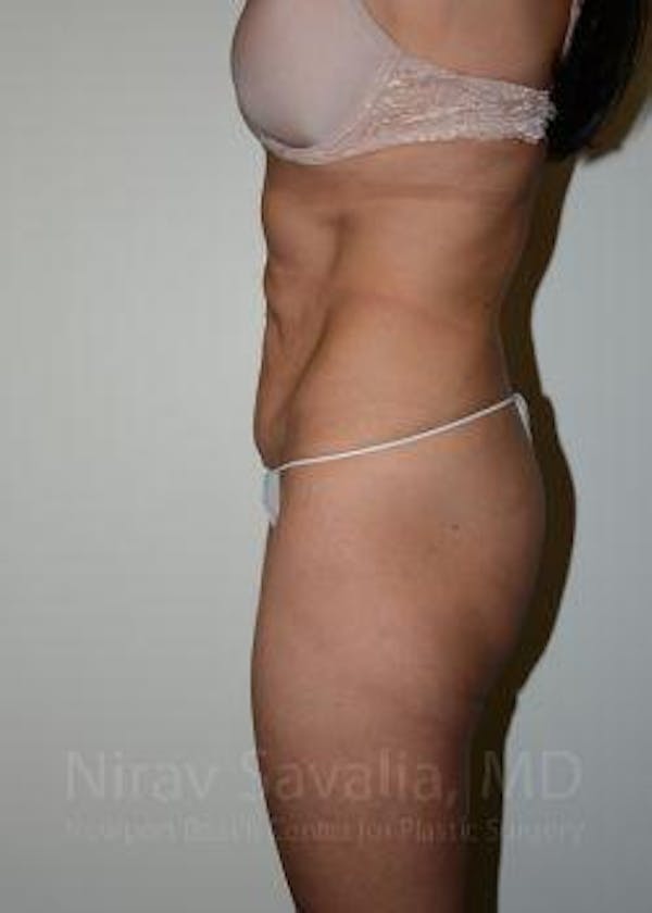 Liposuction Before & After Gallery - Patient 1655645 - Before