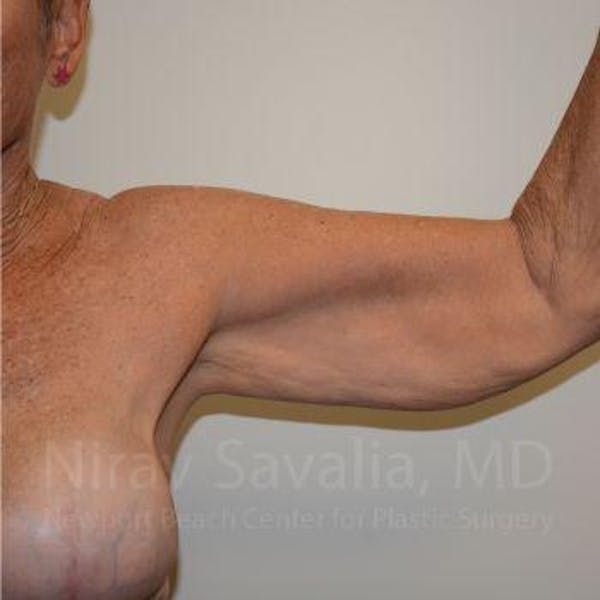 Oncoplastic Reconstruction Before & After Gallery - Patient 1655646 - Before