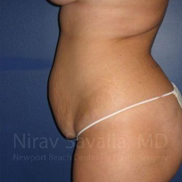 Breast Lift with Implants Before & After Gallery - Patient 1655647 - Before