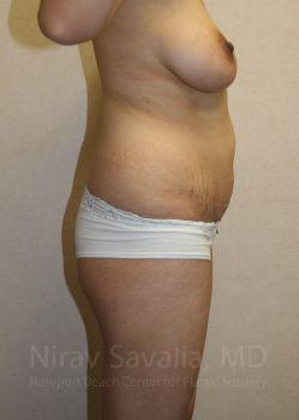 Breast Explantation En Bloc Capsulectomy Before & After Gallery - Patient 1655648 - Before