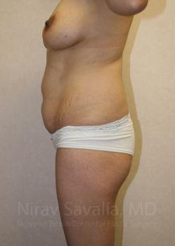 Breast Explantation En Bloc Capsulectomy Before & After Gallery - Patient 1655648 - Before