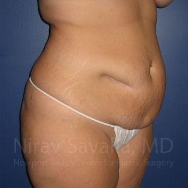 Body Contouring after Weight Loss Before & After Gallery - Patient 1655647 - Before