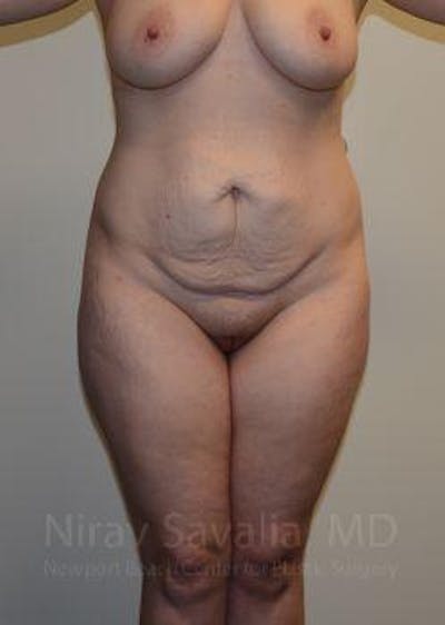 Thigh Lift Before & After Gallery - Patient 1655652 - Before