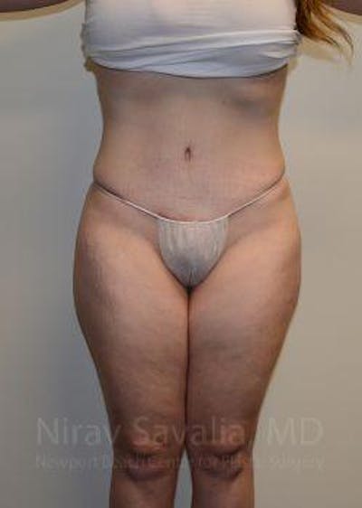 Mastectomy Reconstruction Before & After Gallery - Patient 1655652 - After
