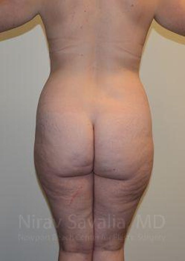 Breast Lift with Implants Before & After Gallery - Patient 1655652 - Before