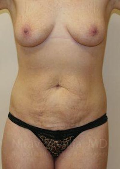 Breast Reduction Before & After Gallery - Patient 1655651 - Before