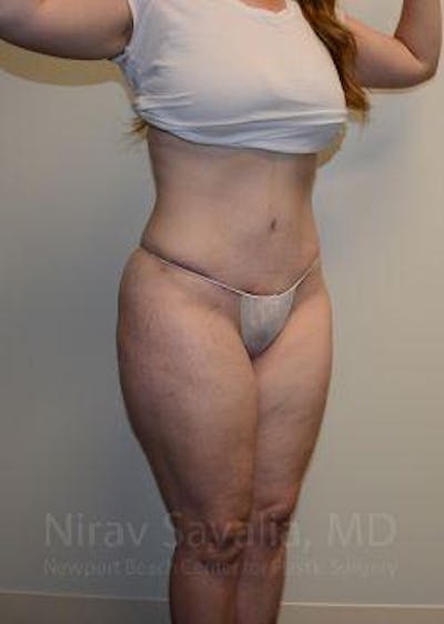 Thigh Lift Before & After Gallery - Patient 1655652 - After