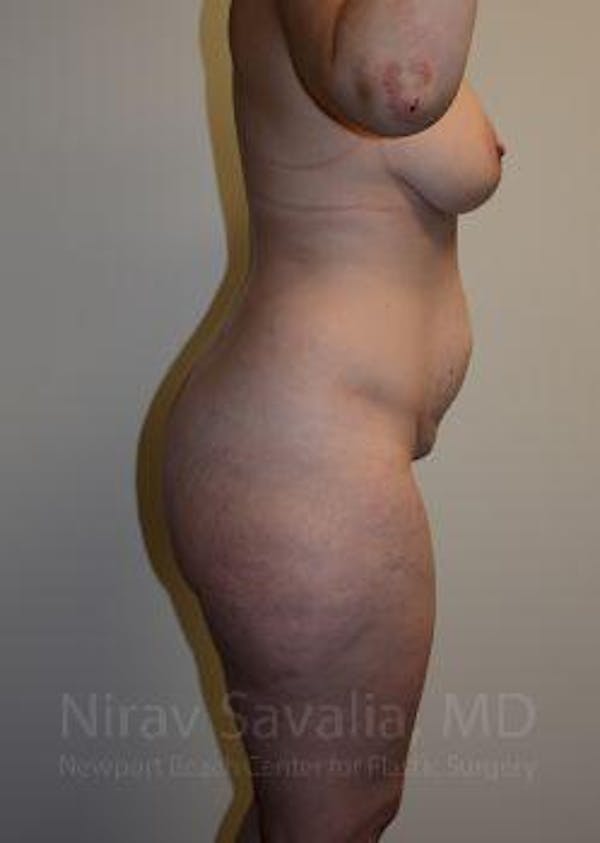 Body Contouring after Weight Loss Before & After Gallery - Patient 1655652 - Before