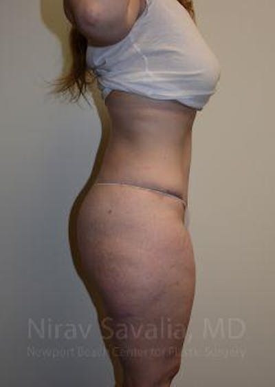 Mastectomy Reconstruction Before & After Gallery - Patient 1655652 - After