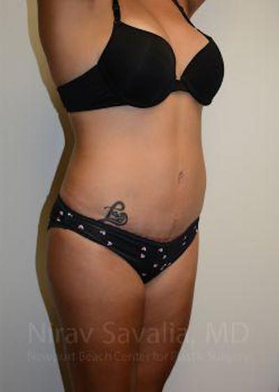 Thigh Lift Before & After Gallery - Patient 1655653 - After