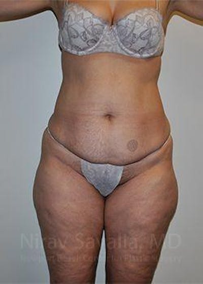 Breast Lift with Implants Before & After Gallery - Patient 1655654 - Before