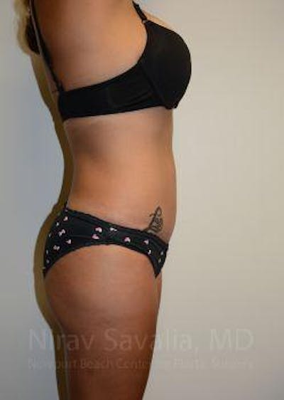 Thigh Lift Before & After Gallery - Patient 1655653 - After