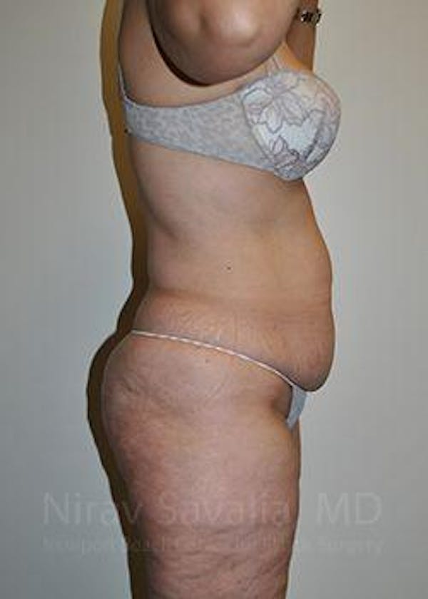 Breast Reduction Before & After Gallery - Patient 1655654 - Before