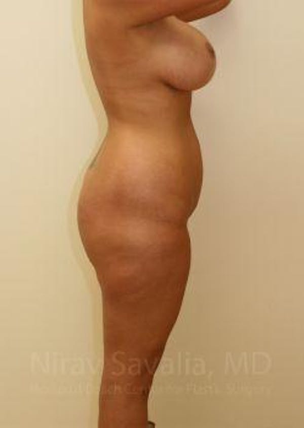 Thigh Lift Before & After Gallery - Patient 1655656 - Before