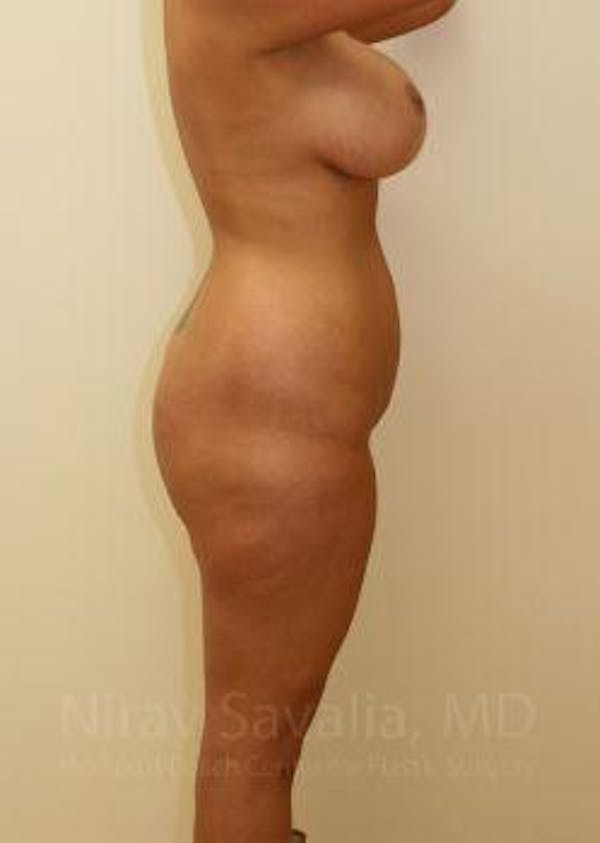 Breast Lift with Implants Before & After Gallery - Patient 1655656 - Before