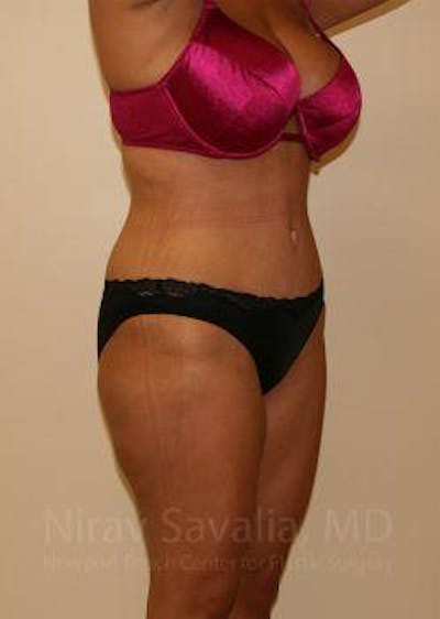 Breast Lift with Implants Before & After Gallery - Patient 1655656 - After