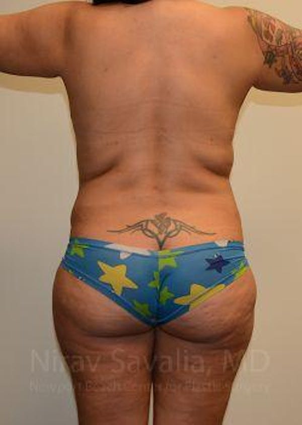 Thigh Lift Before & After Gallery - Patient 1655657 - Before