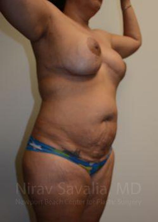 Breast Lift with Implants Before & After Gallery - Patient 1655657 - Before