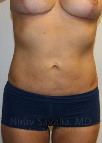 Mastectomy Reconstruction Before & After Gallery - Patient 1655658 - After