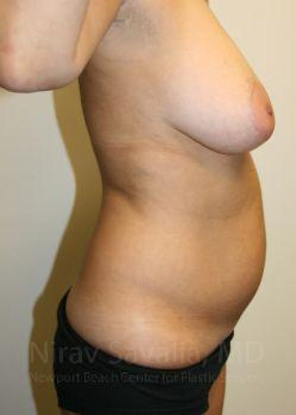 Breast Lift with Implants Before & After Gallery - Patient 1655658 - Before