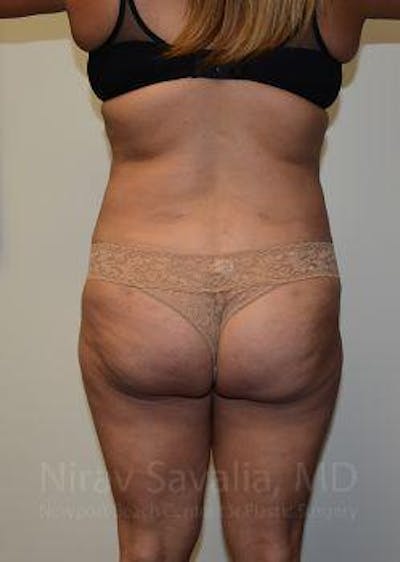 Thigh Lift Before & After Gallery - Patient 1655659 - After