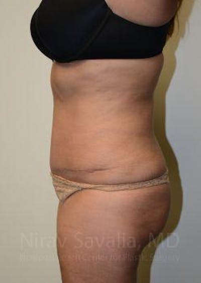 Liposuction Before & After Gallery - Patient 1655659 - After