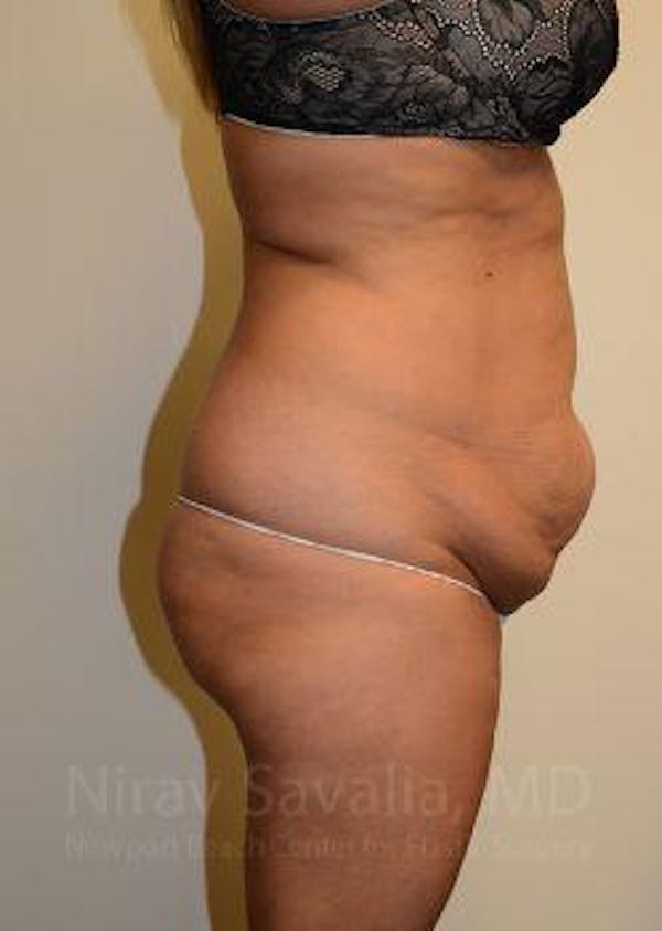 Body Contouring after Weight Loss Before & After Gallery - Patient 1655659 - Before