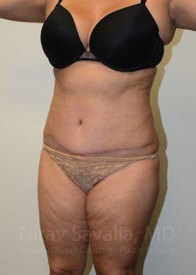 Breast Lift without Implants Before & After Gallery - Patient 1655659 - After