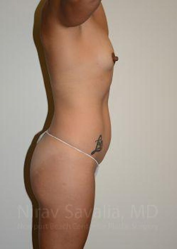 Breast Explantation En Bloc Capsulectomy Before & After Gallery - Patient 1655662 - Before