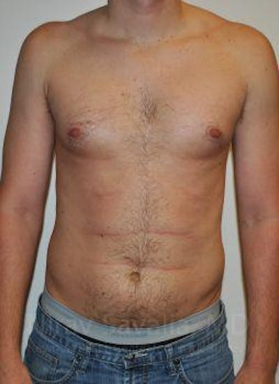 Abdominoplasty Tummy Tuck Before & After Gallery - Patient 1655667 - Before