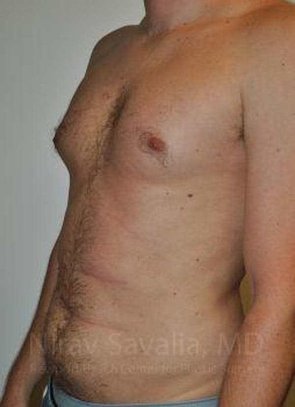 Breast Reduction Before & After Gallery - Patient 1655667 - Before