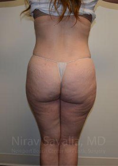 Breast Lift with Implants Before & After Gallery - Patient 1655670 - After