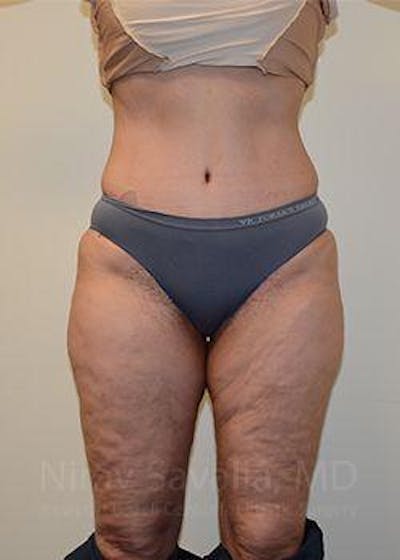 Thigh Lift Before & After Gallery - Patient 1655672 - After