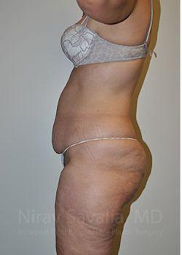 Thigh Lift Before & After Gallery - Patient 1655672 - Before