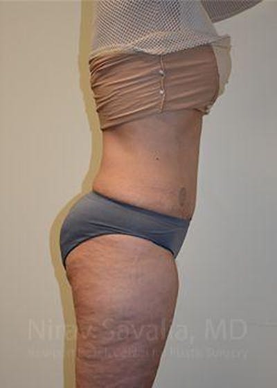 Body Contouring after Weight Loss Before & After Gallery - Patient 1655672 - After