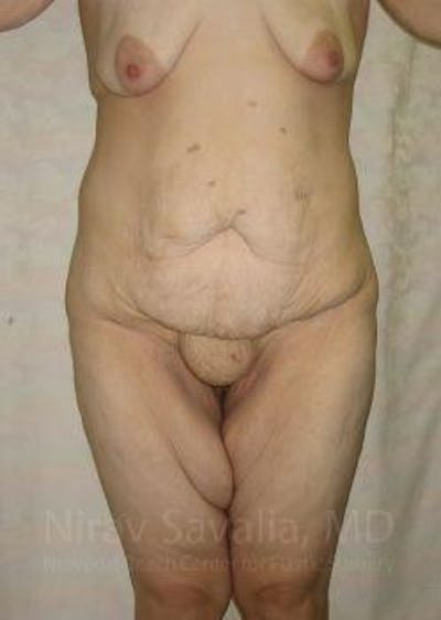 Liposuction Before & After Gallery - Patient 1655677 - Before