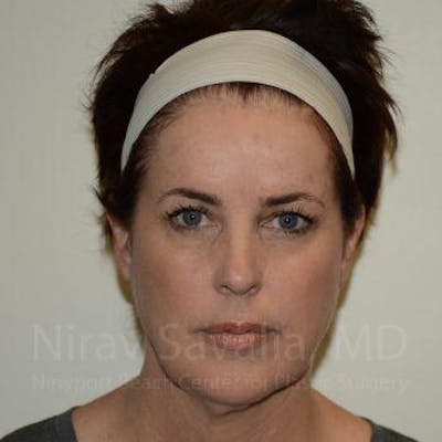 Chin Implants Before & After Gallery - Patient 1655683 - Before