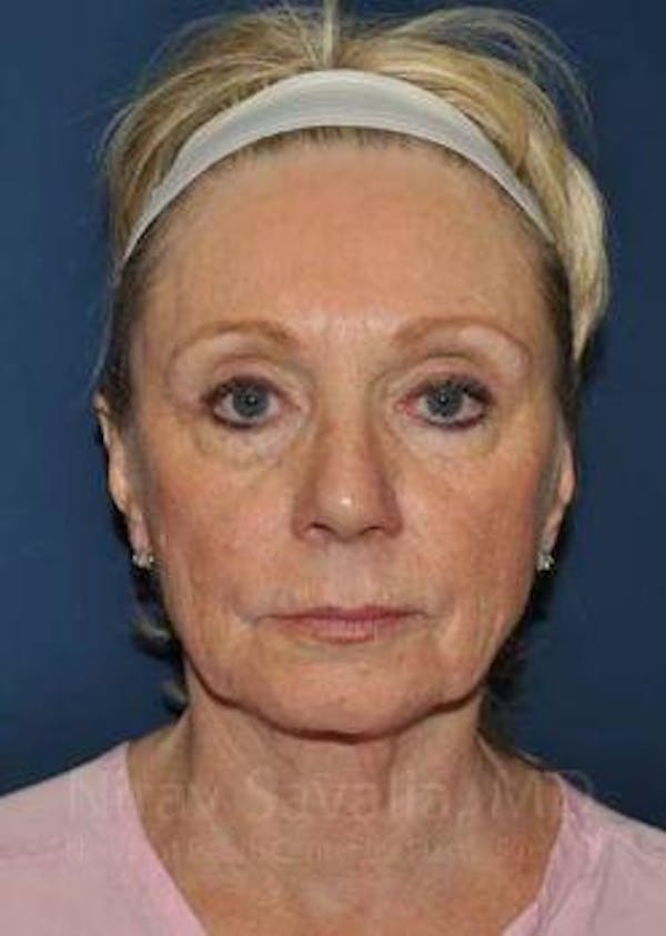 Oncoplastic Reconstruction Before & After Gallery - Patient 1655682 - Before