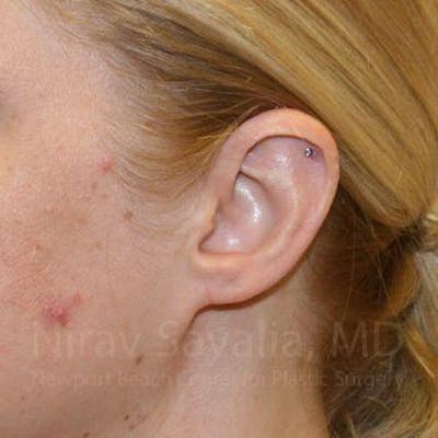 Chin Implants Before & After Gallery - Patient 1655679 - After