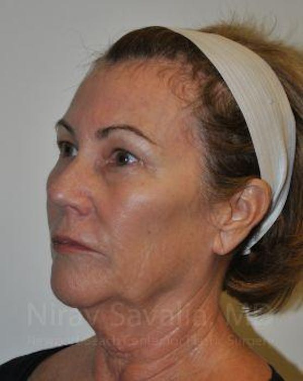 Oncoplastic Reconstruction Before & After Gallery - Patient 1655680 - Before