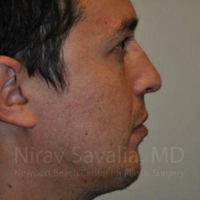 Liposuction Before & After Gallery - Patient 1655678 - After